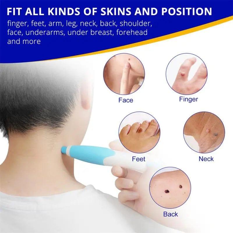 2 In1 Painless Auto Skin Tag Mole Wart Removal Kit - JackedDeals